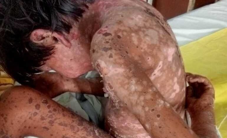 परिजनों का आरोप- टीका लगने के बाद बिगड़ी 5 साल की मासूम की तबीयत परिजनों का आरोप- टीका लगने के बाद बिगड़ी 5 साल की मासूम की तबीयत kshititech